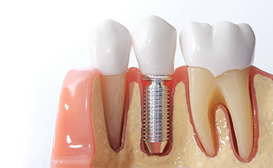 歯を失ったときの治療法～インプラント・入れ歯治療～