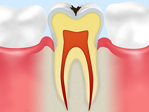 C1（エナメル質の虫歯）