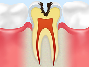 C2（象牙質の虫歯）