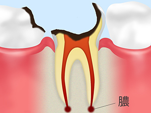 C4（末期の虫歯）