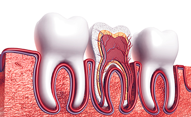 天然歯の根を残す根管治療