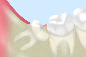 【親知らずの痛みもご相談ください】