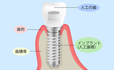 インプラント治療とは？