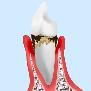 【後期】中等度歯周炎