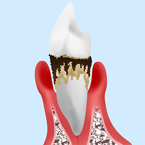 【末期】重度歯周炎
