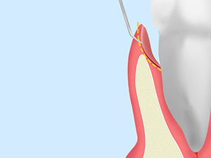 歯周ポケットそうは術