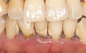 当院の歯周病治療症例 Before