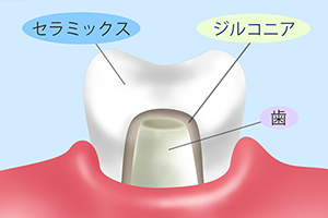 ジルコニア